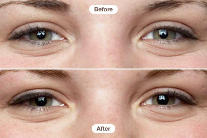 Before After Eye Cream Result